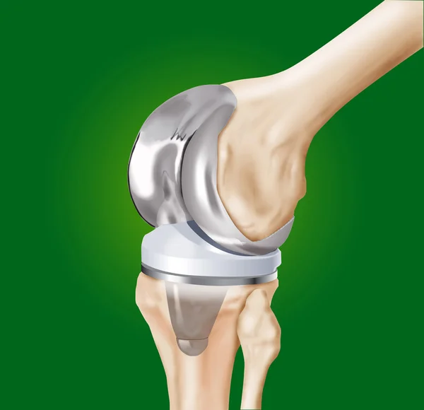 Prosthesis of the knee — Stock Photo, Image