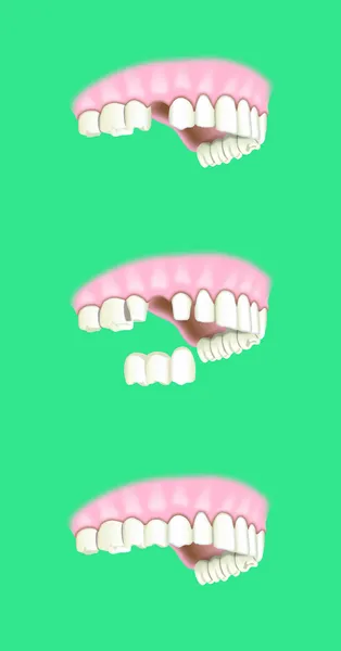 口腔修复体干预 — 图库矢量图片