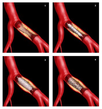 Coronary stent clipart