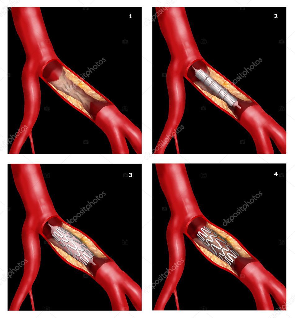 Coronary stent